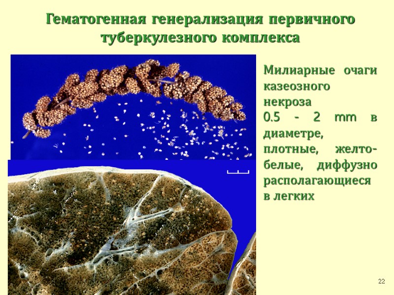 Милиарные очаги казеозного некроза 0.5 - 2 mm в диаметре, плотные, желто-белые, диффузно располагающиеся